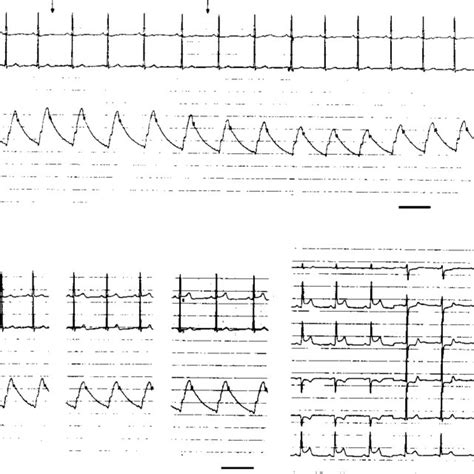 ECG at baseline and after carotid sinus massage. Ischaemic ECG change... | Download Scientific ...