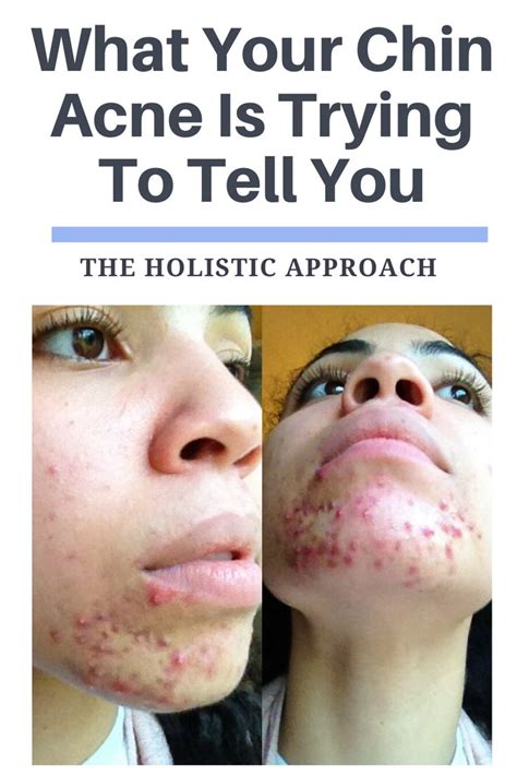 What Your Chin Acne Is Trying To Tell You | Chin acne, How to get rid ...