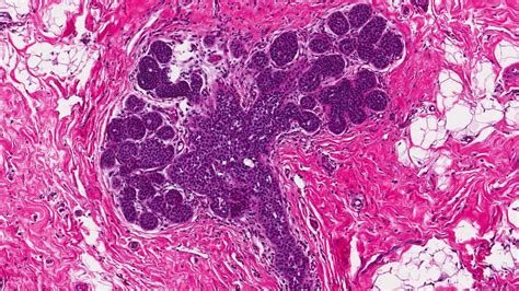 lobular carcinoma in situ Archives | Ottawa Atlas of Pathology