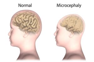 Microcephaly : Causes, transmission, symptoms, & prevention | FactDr