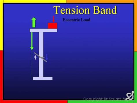 Tension Band Wiring