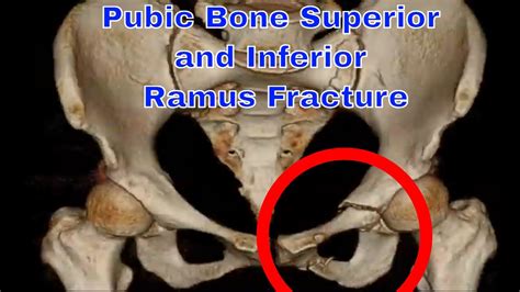 pubic bone superior and inferior ramus fracture - YouTube