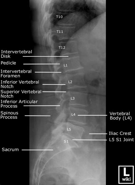 Lumbar Spine Radiographic Anatomy - wikiRadiography