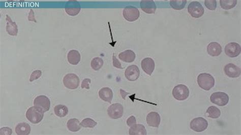 Hemolysis | Definition, Causes & Treatments - Lesson | Study.com