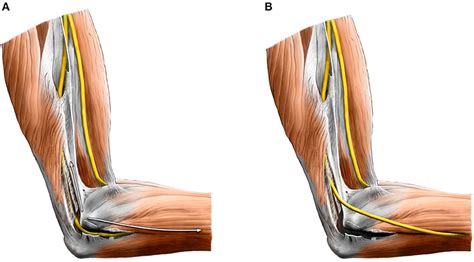 Frontiers | Ulnar Neuropathy at the Elbow: From Ultrasound Scanning to Treatment