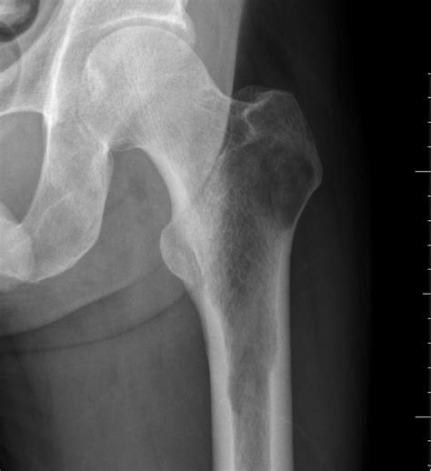 Benign lucent bone lesions | Radiology Case Collection | Radshare.net