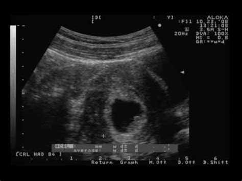 Ultrasound 7 weeks 3 days - TWINS! - YouTube