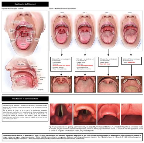Mallampati y Cormack Lehane - Clasificación de Mallampati Mallampati 1 se caracteriza por la ...