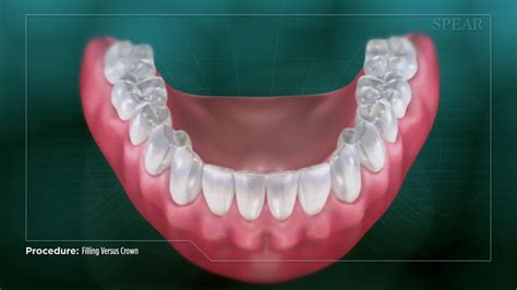 Filling vs Crown - Dental Clinic