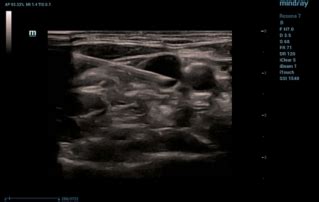 Ultrasound Journal 20 - Features of Subcutaneous Venous Port Systems Implantation Using ...