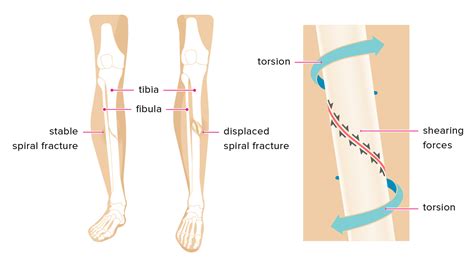 Spiral Fracture: Healing Time, Tibia, and Fibula