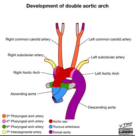 Variant anatomy of the aortic arch | Radiology Reference Article | Radiopaedia.org