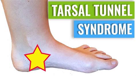 Tarsal Tunnel Syndrome Exercises