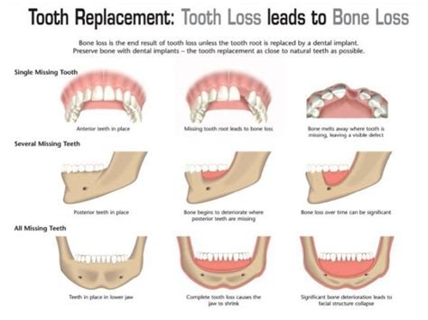 How Dental Implants Stop Jaw Bone Loss