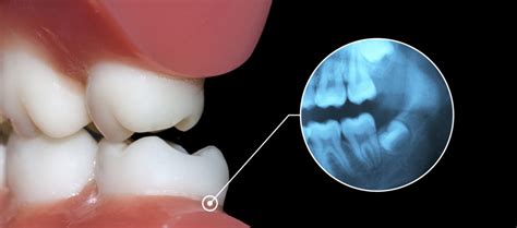 Occlusal Adjustment - Sparacino Periodontics