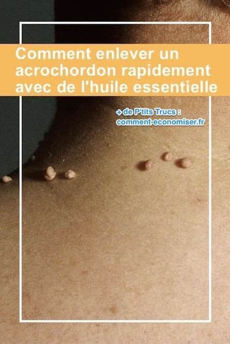 Comment Enlever un Acrochordon RAPIDEMENT Avec de l'Huile Essentielle ...