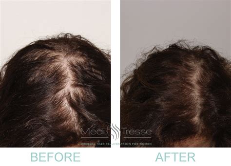 Low Level Laser Therapy For Hair Loss Wellesley & Boston, MA - Medi Tresse