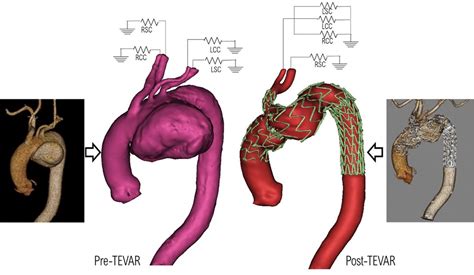 Frontiers | Aortic haemodynamics and wall stress analysis following arch aneurysm repair using a ...