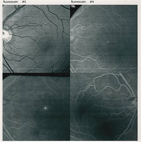 Central Serous Chorioretinopathy Houston | Mann Eye Institute Austin