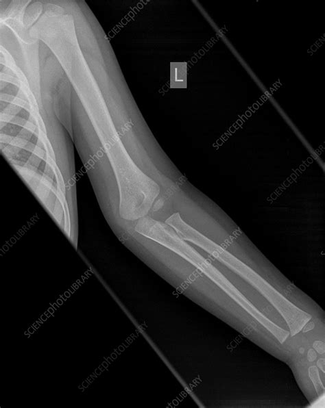 Supracondylar humerus fracture, X-ray - Stock Image - C056/4172 - Science Photo Library