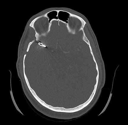 Aneurysm Clips - MR IMPLANT