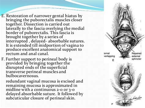 Perineal lacerations