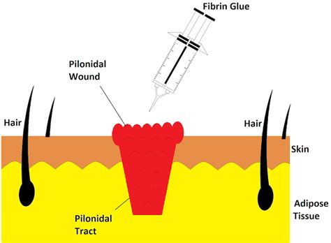 What Is Fibrin Glue: Detailed Information