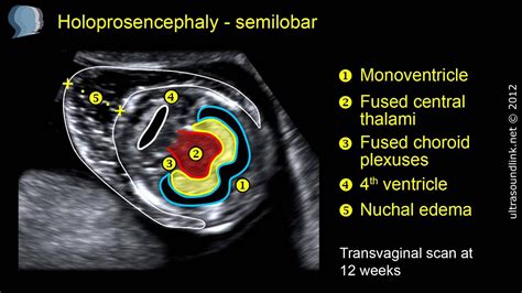 Semilobar holoprosencephaly: 2D and 3D ultrasound - YouTube