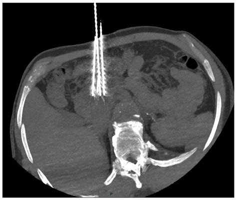 Life | Free Full-Text | Interventional Radiology in the Treatment of Pancreatic Adenocarcinoma ...