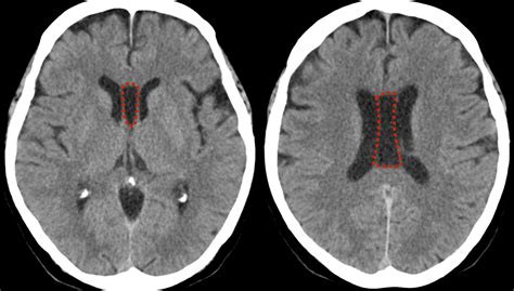 Velum Interpositum Anatomy at John Voss blog