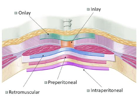 EuraHS terminology of mesh positions during ventral hernia repair ...