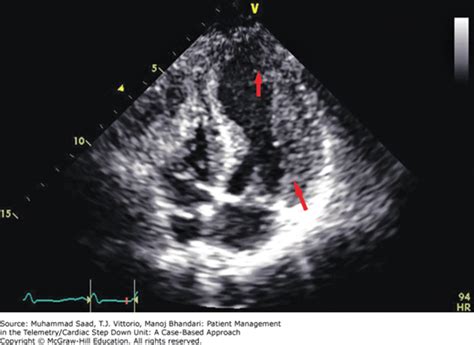 Abnormal Echocardiogram Results