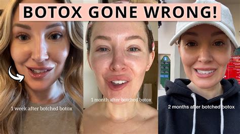 I Got Botched Botox | Before and After Bad Botox - YouTube