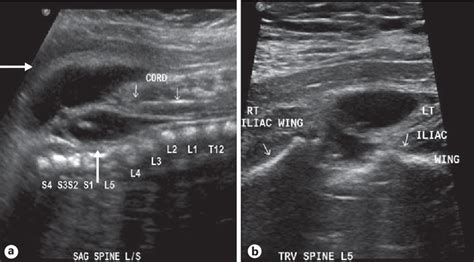 Figure 18 from The Diagnostic Features of Spina Bifida: The Role of Ultrasound | Semantic Scholar