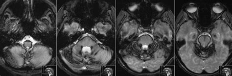 Radiology MRI: Superficial Siderosis