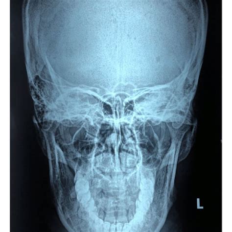 X-ray-Towne's view showing elongated styloid process | Download Scientific Diagram