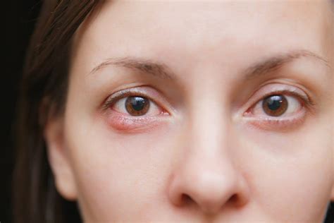 How to Get Rid of a Stye | Valley Eyecare Center | Eye Doctors in ...