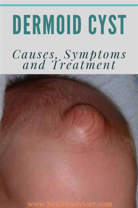 Dermoid Cyst: Causes, Picture, Symptoms And Treatment