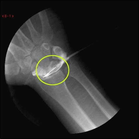 Mri Of Torn Tendon In Left Ankle