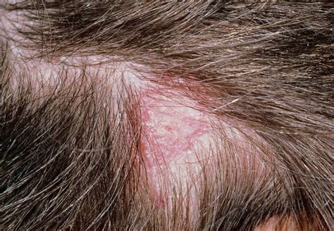 Seborrheic Dermatitis Scalp