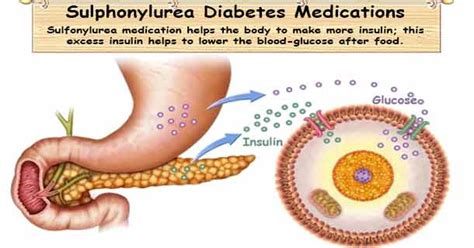Sulfonylurea Glipizide Glyburide