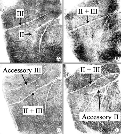 Types of palm creases based on the relationship between the proximal... | Download Scientific ...