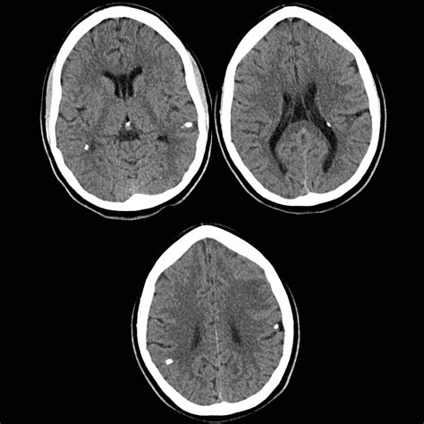 Cmv Periventricular Calcification