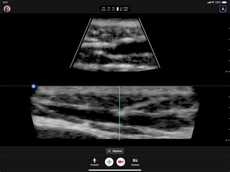 Point of care ultrasound at the bedside in E Med | Butterfly iQ3