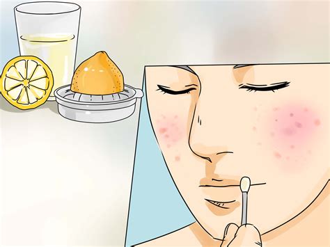 How To Reduce Zits - Phaseisland17