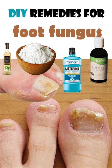 The 25+ best Toe fungus cure ideas on Pinterest | Toenail fungus ...