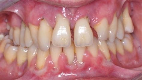 A new genetic approach to identify those at high risk of generalized aggressive periodontitis ...