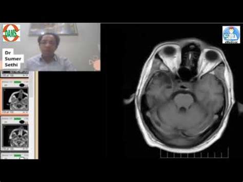 Gliosis-Encephalomalacia-MRI - Sumer's Radiology Blog