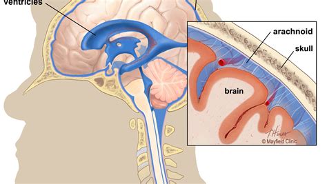 Ohio State's Urban Meyer has one, so what is an arachnoid cyst?