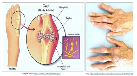 Gout = Pathophysiology of Gout | Gout | What is Gout | Causes of Gout | Pharmacology of Gout ...